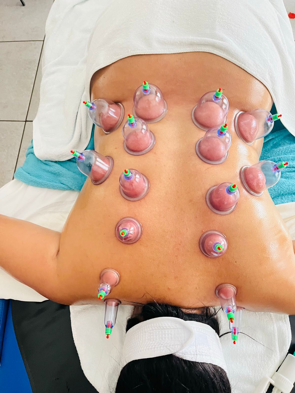 Cupping treatment included with selected spa packages.
